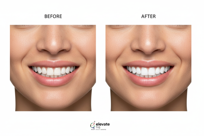 Before and after teeth whitening results